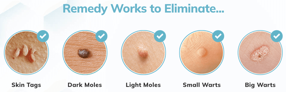 Remedy Skin Tag Remover works to eliminate